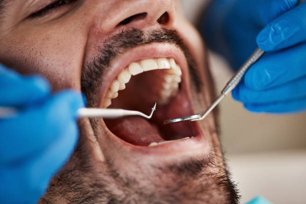 Best Emergency Root Canal Treatment in Washington Court House, OH